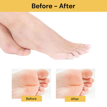 6Pcs Corn Remover Pads