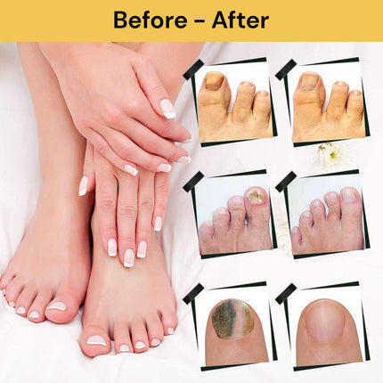 Nail Fungal Treatment Solution