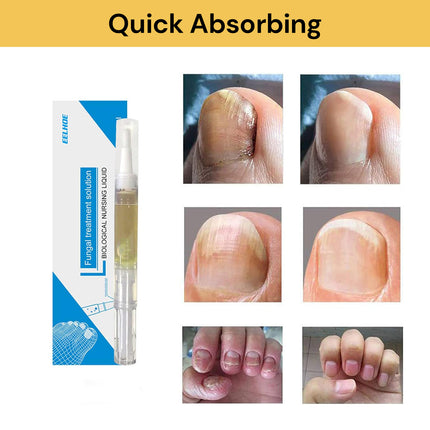 Nail Fungal Treatment Solution