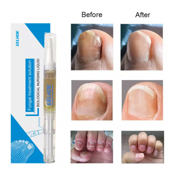 Nail Fungal Treatment Anti Fungus Biological Nail Repair Solution Fingernail Treatment Toenail Treatment 2021-08-20_1__1